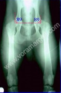 RADIOGRAFIA ESTANDAR con medición de ángulos. 