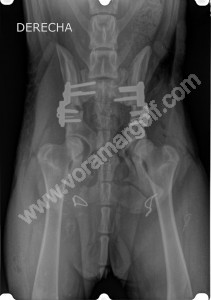 RADIOGRAFIA. Resolución quirúrgica del caso anterior. Tripe osteotomía de ambas caderas. 