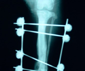 Fractura de tibia y resolución quirúrgica